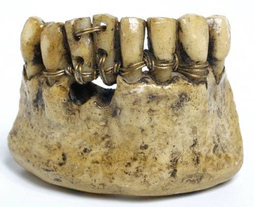 Etruscan Dental Innovations: A Glimpse Into Ancient Dentistry